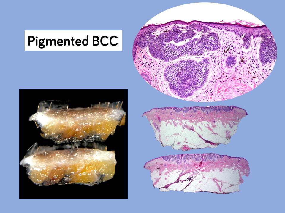carles_saus's tweet photo. Lesion submitted as BCC. While grossing it, I thought it’d be melanoma. I was wrong. Dermatologist was right. #dermatology #melanoma #dermoscopy #Pathology #GrossPath #pathologists https://t.co/9PFT0HywmP