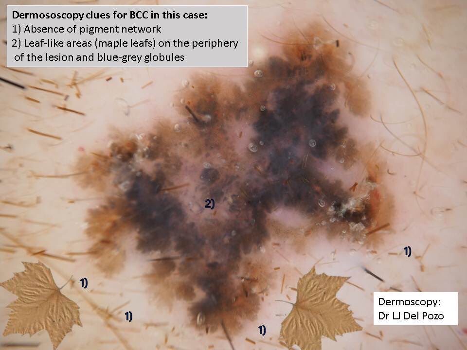 carles_saus's tweet photo. Lesion submitted as BCC. While grossing it, I thought it’d be melanoma. I was wrong. Dermatologist was right. #dermatology #melanoma #dermoscopy #Pathology #GrossPath #pathologists https://t.co/9PFT0HywmP