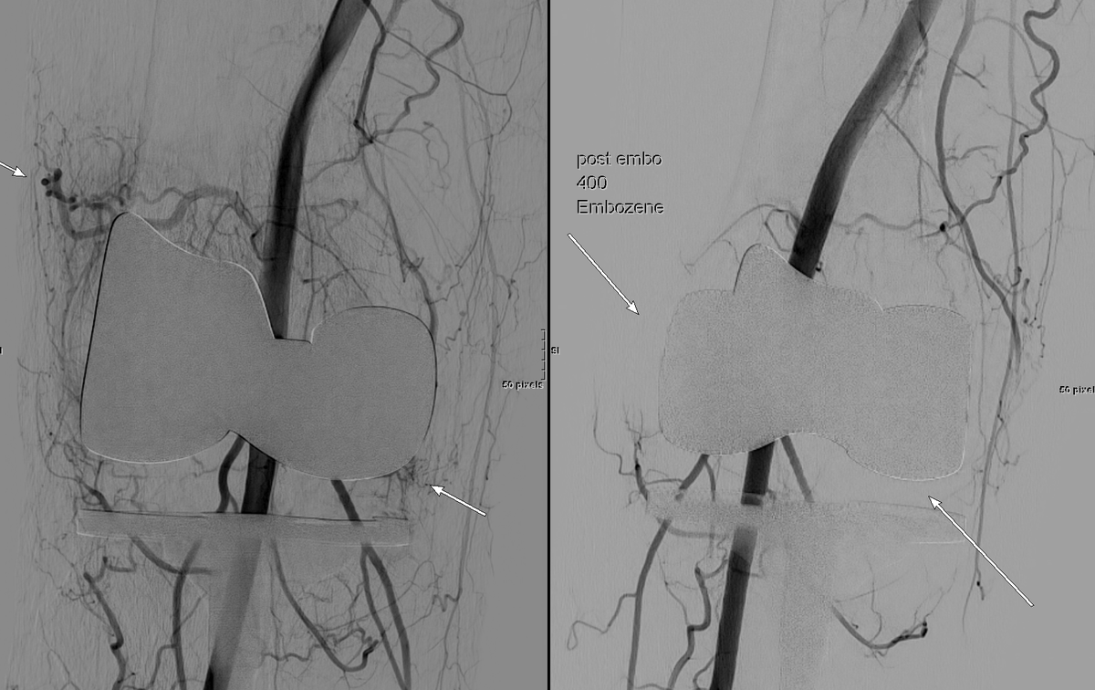 bonesz's tweet photo. #Geniculate artery embolization with @bostonsci #Embozene for recurrent #hemarthrosis post TKR @MountSinaiIR #IRad @sportsmednyc #withoutascalpel @EVToday https://t.co/wlX9B9KxOX