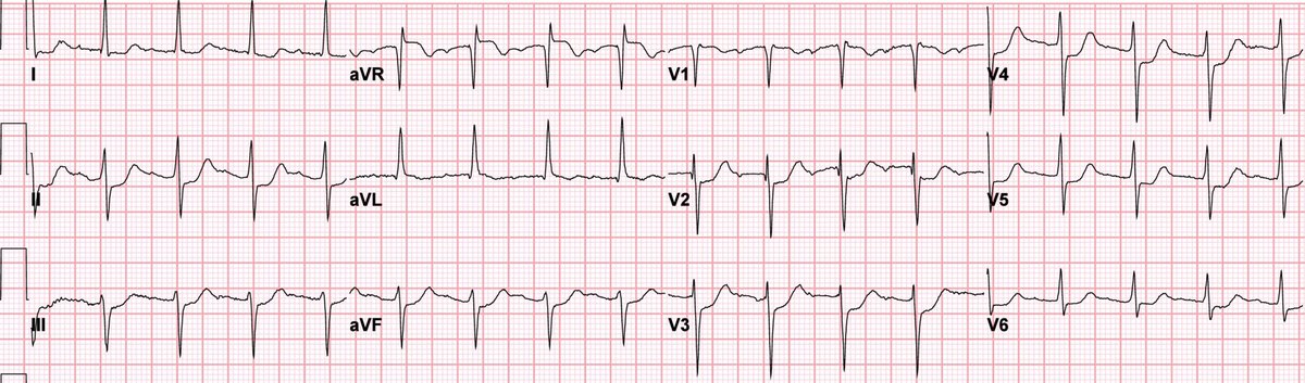 EM_RESUS's tweet photo. A 75-year-old man with sudden onset chest pain and shortness of breath.   

What’s the diagnosis? https://t.co/VAc9mFRgHf