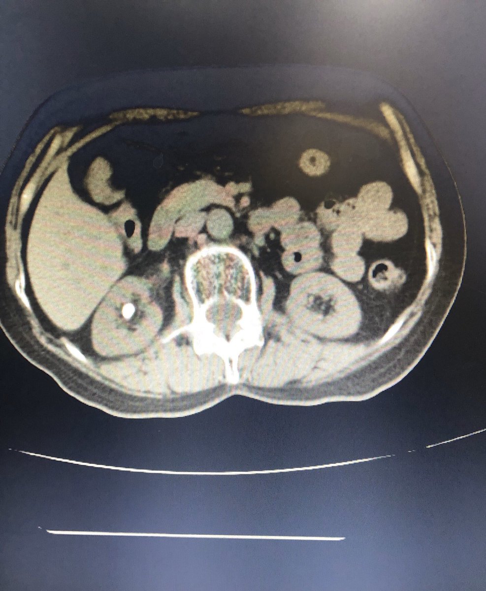 drvicenterivera's tweet image. Primer caso. Listo cáliz inferior derecho 12x12mm 890UH. Realizamos #RIRS con #Pusen. #Xrayfree