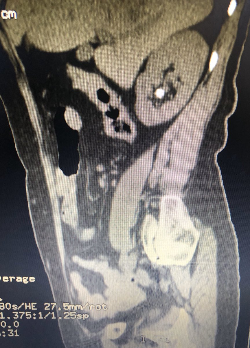 drvicenterivera's tweet image. Primer caso. Listo cáliz inferior derecho 12x12mm 890UH. Realizamos #RIRS con #Pusen. #Xrayfree
