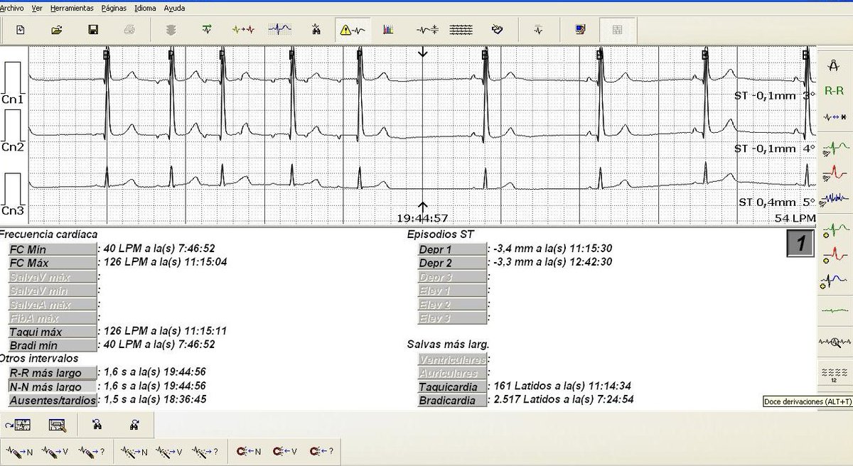 icorvilud's tweet photo. 35 años, deportista. El ECG del centro de salud informa #BIRDHH y su médico le pide un Holter (me lo envía asustado con esteregistro)
Se lo paso a mis estudiantes de medicina
#ECGcorner #LearningECG #cardiologiadeportiva #PreparticipationScreening #sportscardiology https://t.co/kefuCi1nXP