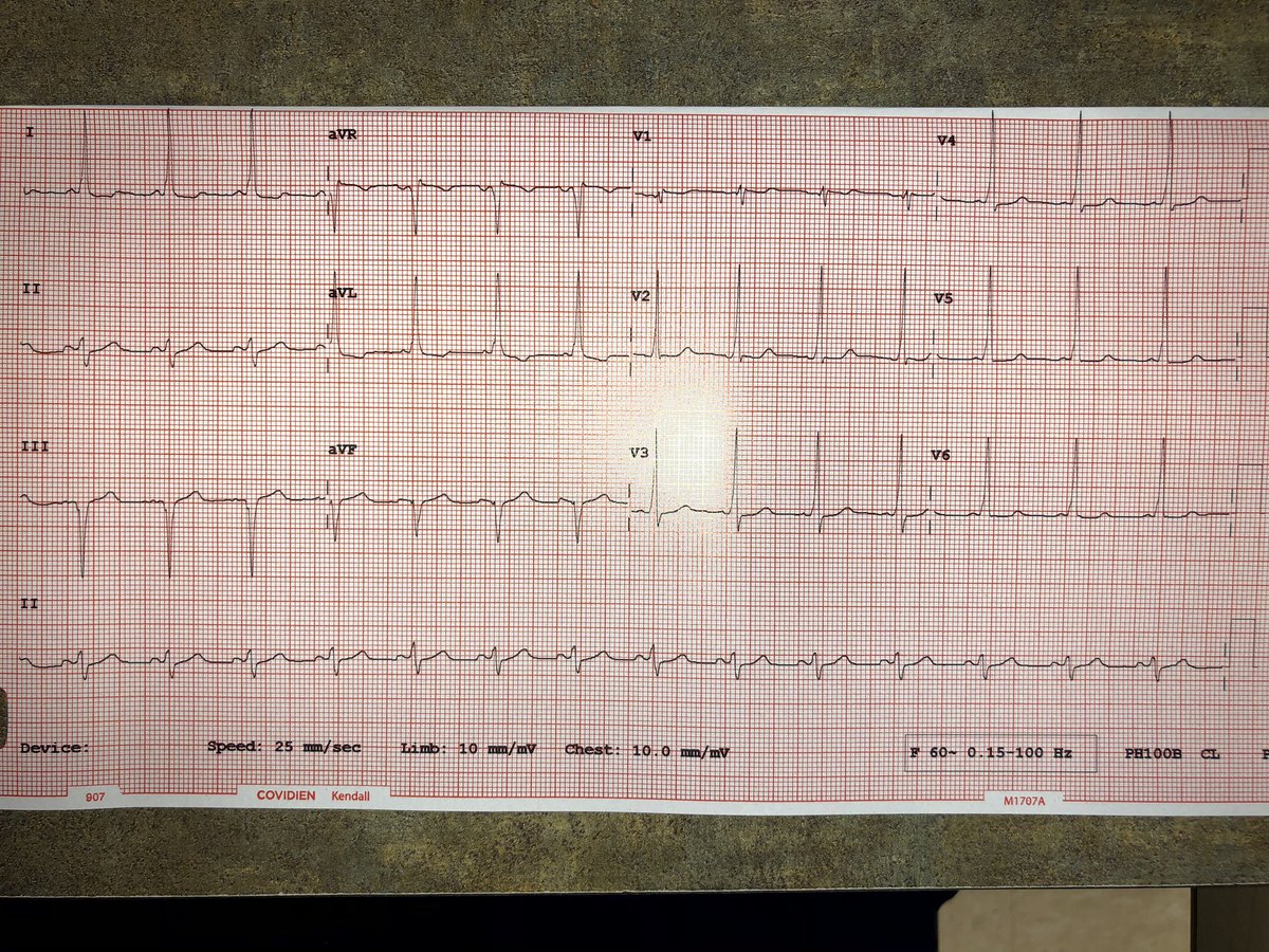 sebascuevas's tweet photo. You have to be knowledgeable in order to help your patients. I’m thankful for #FOAMed and for @smithECGBlog @emcrit
39M, dizziness and brief syncope. Pre-excitation syndrome. Referred to EP.
#DeltaWaves #ShortPR https://t.co/ZPkxE6MMMM