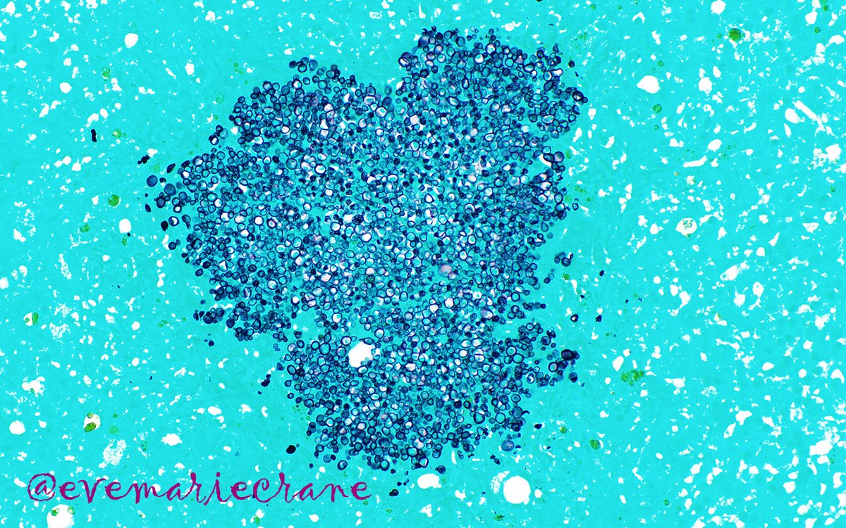 evemariecrane's tweet photo. Drs. Crane &amp; Craney join forces next week for a very special micro rounds @WCMCPathology! Topics include common post-stem cell transplant infectious complications, including this one involving the bone marrow.  Any guesses as to its identity? Join us Thurs Dec 12, 11 am in micro! https://t.co/UxGKld160E