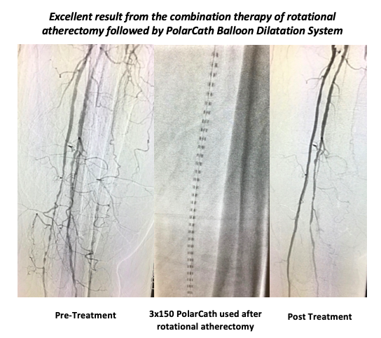 nucryo's tweet photo. Excellent below-the-knee (BTK) case by Dr. Raj Dave. Combination treatment of rotational atherectomy by @csi360  followed by a 3.0 x 150 PolarCath from @nucryo    Great result with excellent blood flow to the foot!  Well Done! https://t.co/ZqEVDzzbKr
