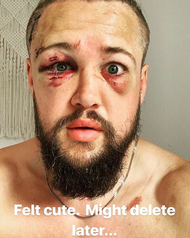 DalbyMMA's tweet image. That day after a certain very memorable fight at a @cagewarriors show in London. How the hell did my FaceID even work with me looking like this? 😂
#TBT | #Throwback | #RedWedding ift.tt/2OQSBng