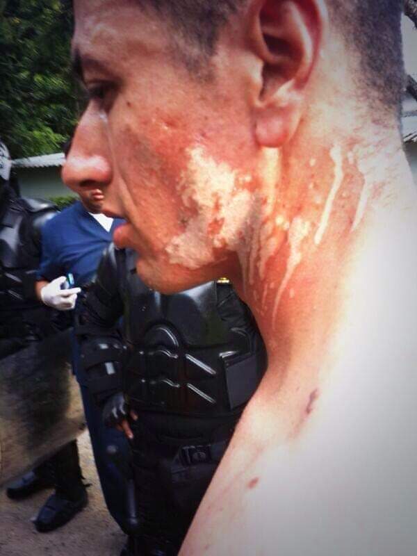 Macare1501's tweet photo. Ayer en Univalle lanzaron artefactos con  ácido  a nuestros policias en Cali !  De verdad esto Duele! 
La humanidad cada vez peor! 
Y por esto si no dicen nada. https://t.co/B7ynRZ4x48 https://t.co/9mGRUHwJla