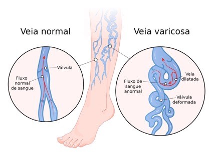 varices vulvaires photos exerciii în prevenirea piciorului în varicoza