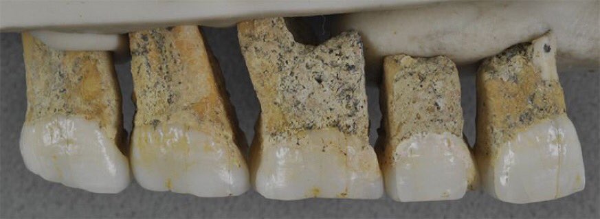 Xavi_Bros's tweet photo. At least 5 species of homo #sapiens lived simultaneously in Asia 50000 years ago: homo sapiens sapiens, neanderthals, denisovans, homo floresiensis and the recently found in Luzon island, homo #luzonensis.
Increible! but only the sapiens sapiens survived: https://t.co/6nAG8DqTdw https://t.co/EgyyyBG9qP