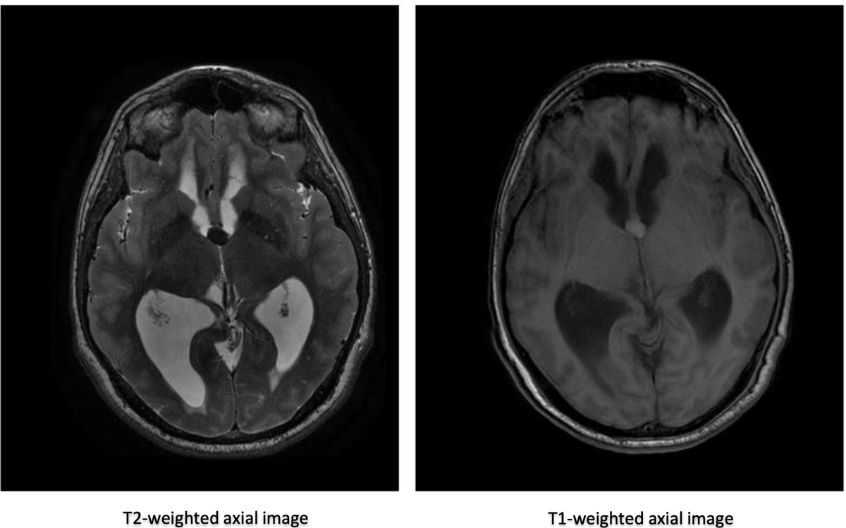 IDKDCourse's tweet photo. IDKD Davos 2020 is coming in  3 months and the topic will be Neuroradiology.  Let's start with some warm up exercises! What is the possible reason for headaches  in this 52-year old? Provided by Prof. B. Ertl-Wagner at our #FundamentalsInImaging Course in Davos #rasred #IDKD2020 https://t.co/vMnL2eAe2t