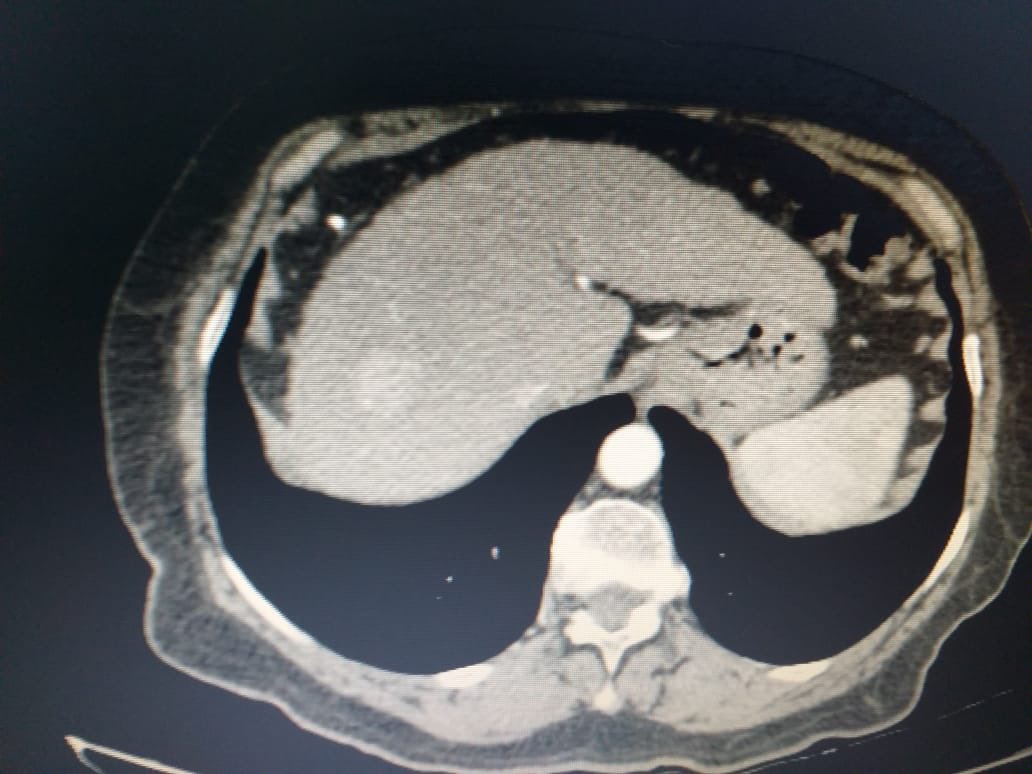 Ablación de Hepatocarcinoma por Radiofrecuencia realizada por el Dr. Agustín Vintimilla. Hospital José Carrasco Arteaga.
.
.
#radiofrecuencia #ablacion #hepatocarcinoma #RFMedical #Invimedic