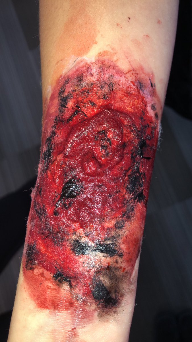 serena_bugli's tweet photo. 3rd degree burn #anatphys @RienasScience https://t.co/AqXwhXeE4X