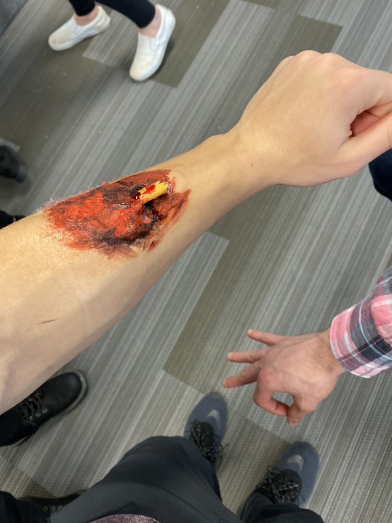 #Anatphysa a laceration from a woodchip <a href="/RienasScience/">RienasScience</a>