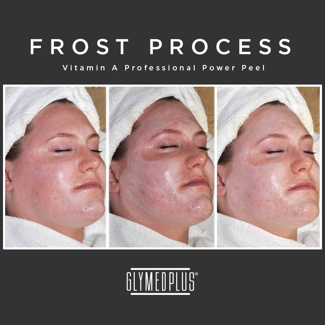 GlyMedPlus's tweet photo. GlyMed Plus Vitamin A Professional Power Peel was used to treat Post Inflammatory Hyperpigmentation! Here you can see the levels of frost at one layer, two layers, and a spot treatment fill layer for a full frost!
#glymedplus #tca #tcapeel #retinol https://t.co/wAxcSZ1NtV