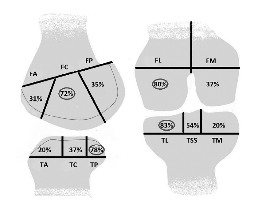 Bone bruise patterns in pediatric #ACL tears resemble those in adults, but lower presence of meniscal tears and chondral lesions suggests a different effect of the injury mechanics in youth
ow.ly/MunS50xpzqZ