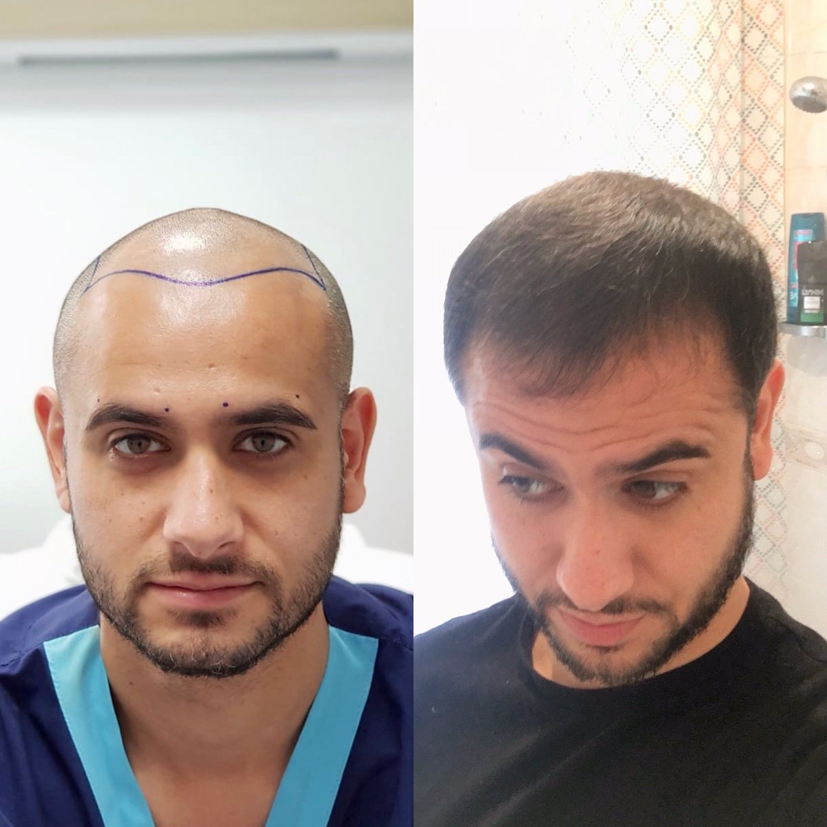 The Hair Transplant Specialist on Twitter: 