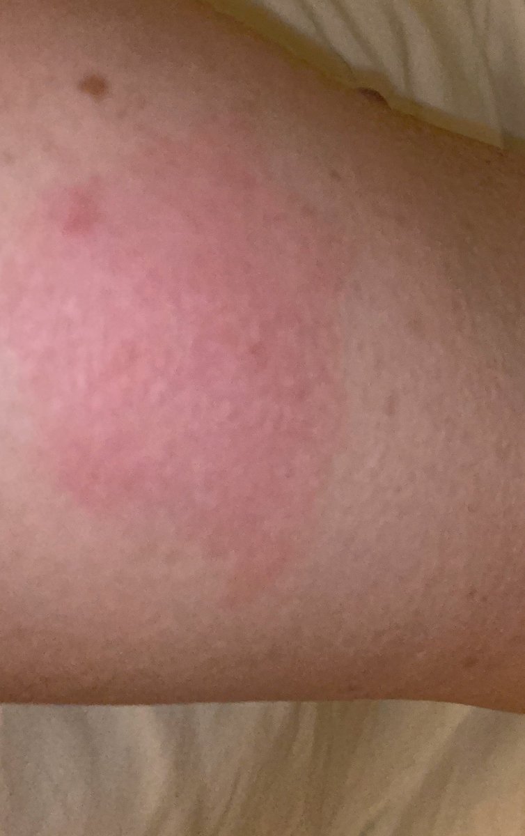 Is this ‘normal’ for flu injection site? Had it yesterday...