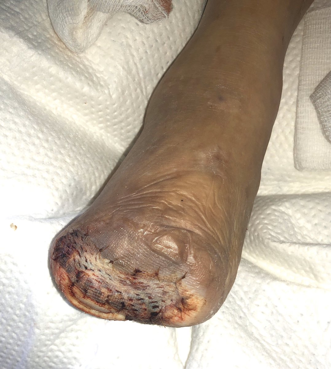 jmills1955's tweet photo. @DrTehan @LessneVIR @kmadass @Watts_IR @TimYatesMD @SriniTummala @DanHan @esambolmd @SIRmembers @VascularSVS @thetoedoctor @Martinfox2000 @dgarmstrong I have a long-standing foot fetish Below a patient treated in two other facilities prior to #BCMSTEP with forefoot gangrene after pedal angioplasty and TMA and STSG (Dr Ross and I) @BCM_Surgery #ToeAndFlow #ComprehensiveVascularSurgery @thetoedoctor @monteromiguel https://t.co/Jn3gLNdzJe