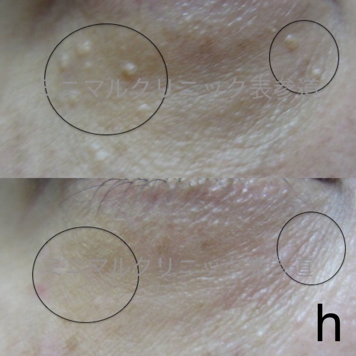 汗管腫 かんかんしゅ エクリン汗嚢腫 稗粒腫 はいりゅうしゅ 目の下のブツブツ レーザー治療専門 On Twitter 7h 専門的にレーザー治療しています 公式サイト Https T Co Y9coxhgk32 レーザー認定医 汗管腫 かんかんしゅ 稗粒腫 はいりゅうしゅ ひ