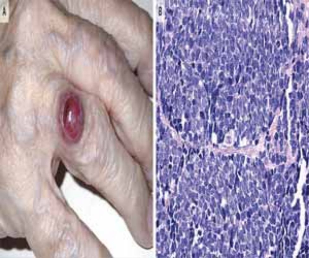 Rare case of Merkel-Cell Carcinoma reported in NEJM #neuroendocrinecancer  @netcancerblog buff.ly/2DQUzxF