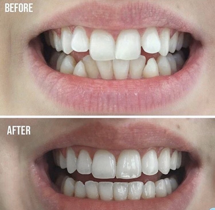ArguelloDr's tweet photo. ORTHODONTICS DAY🤐.
.

And we can give you the best of companies with braces!  Call us, the best orthodontic treatments with the best team of professionals😬👨🏻‍⚕️👩🏻‍⚕️
.
.
#braces #got #love #lips #gum #red #dental #dentist #dentistry #good #company #ortho #orthodontics #tooth #teeth https://t.co/qdEeIJ3vmW