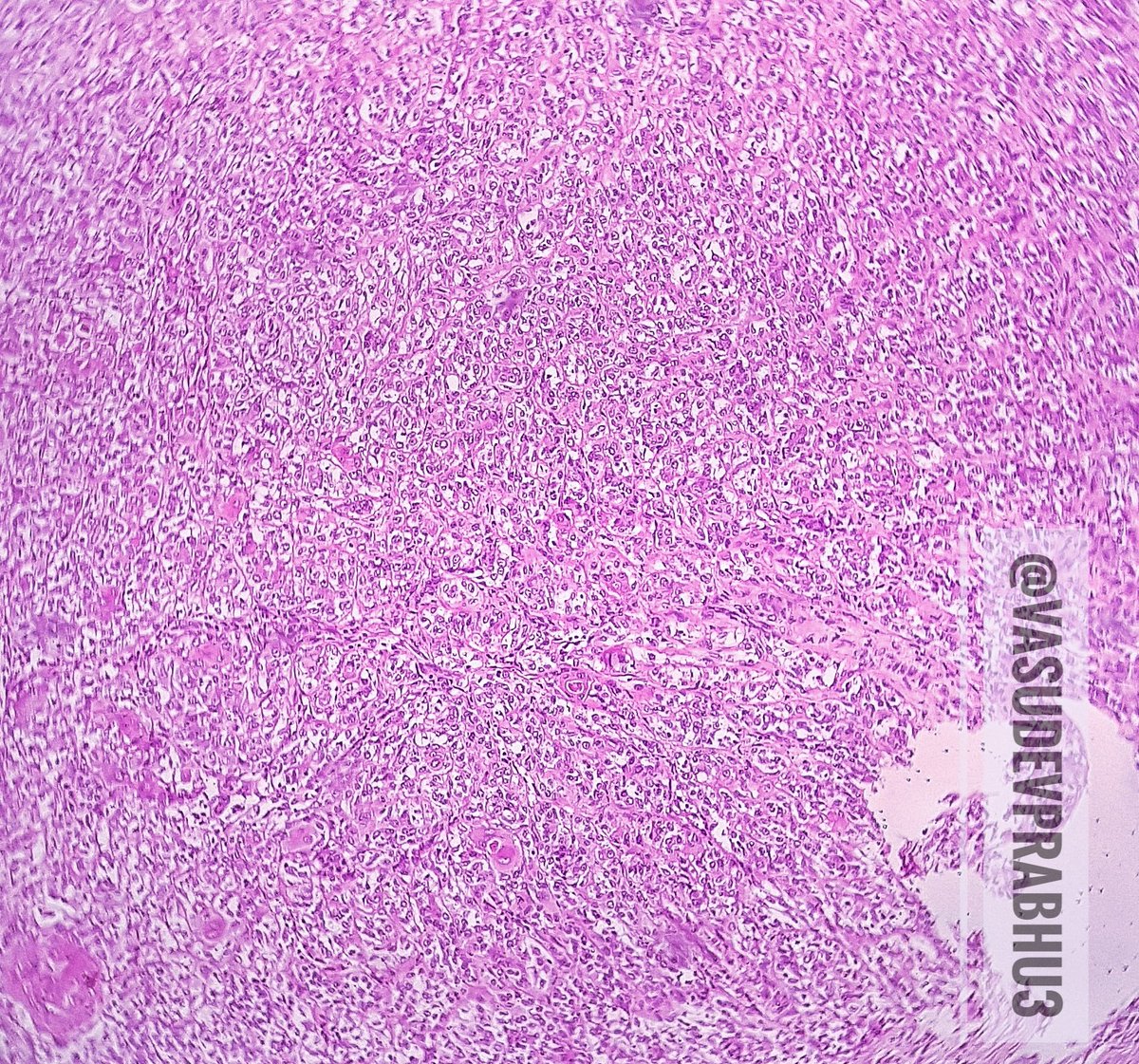 Epithelial myoepithelial carcinoma parotid gland🔬 ☀️biphasic population-myoepithelial and ductal epithelial cells ☀️Myoepithelial cells-voluminous clear cells,polygonal to spindle shaped ☀️Small ductal cells ☀️Infiltration. ☀️Mild Cytological atypia ☀️Stroma-loose,hyalinised.