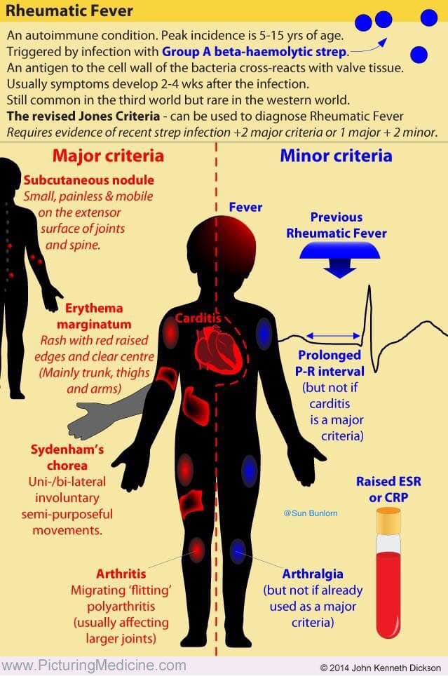 rheumatic fever ce produse pentru boala articulară
