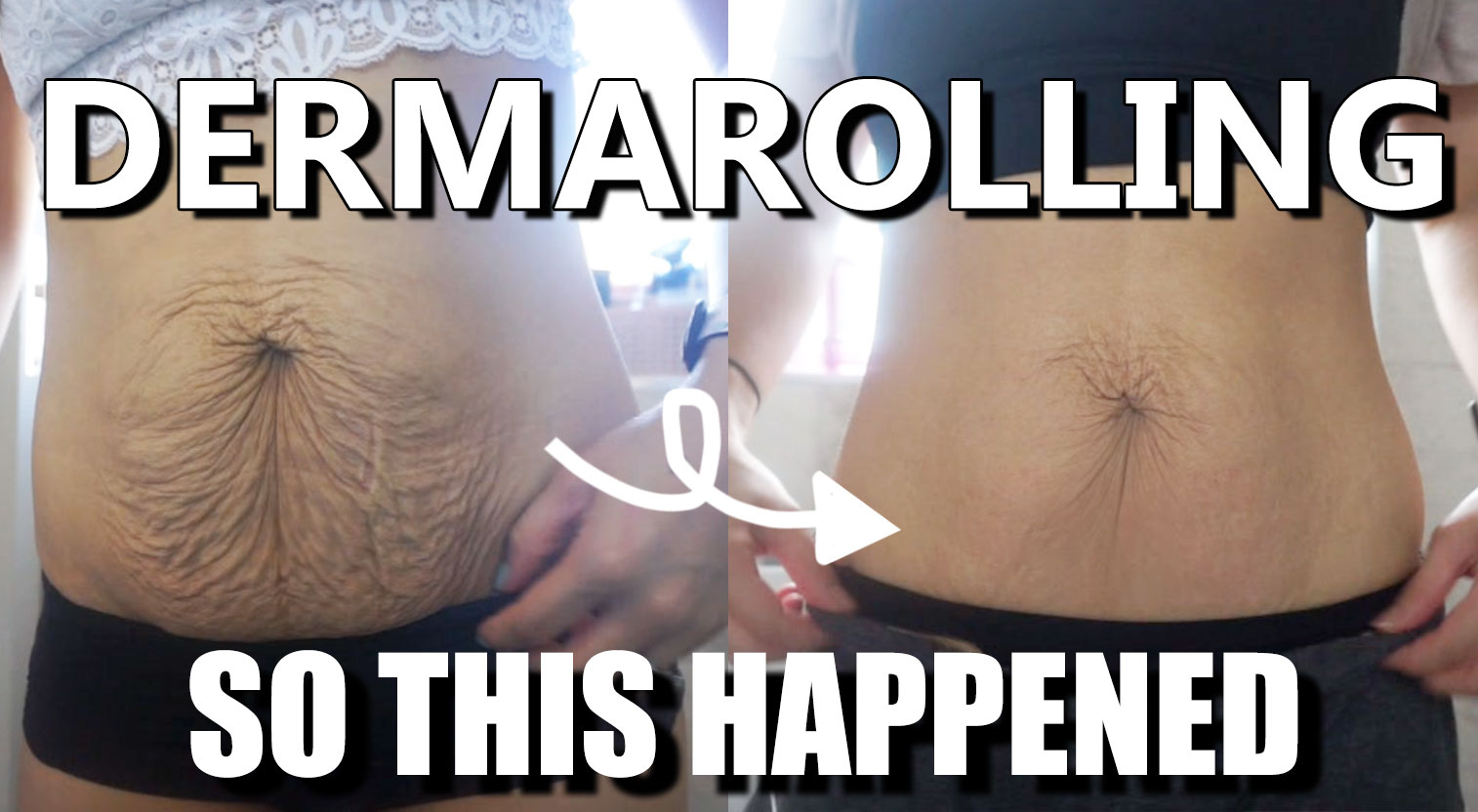 dermarolling stomach
