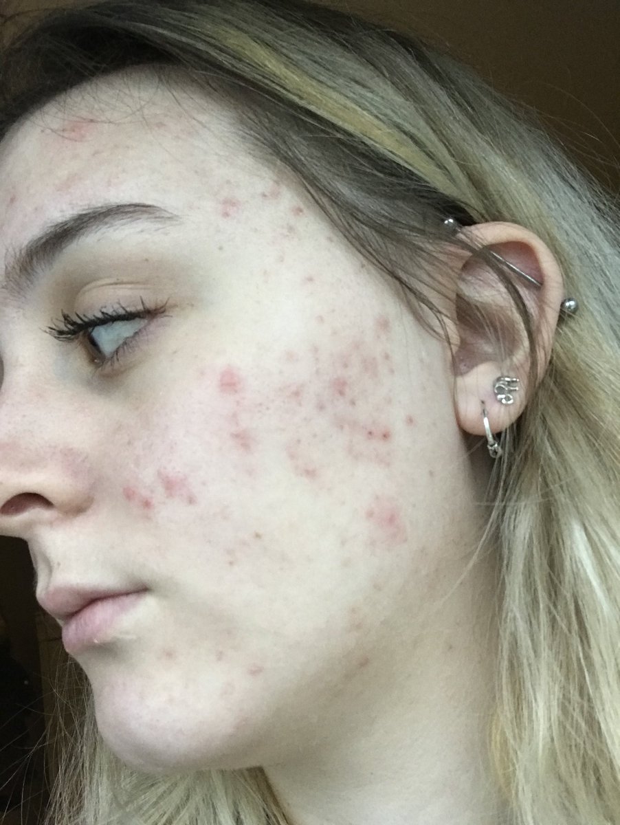 kimche_'s tweet photo. After suffering for 9 years I am finally acne free 🤩 Roccutane may just be the best thing that ever happened to me 🌟 before ➡️ now (no makeup or filter) https://t.co/eKOZIGNBJ7