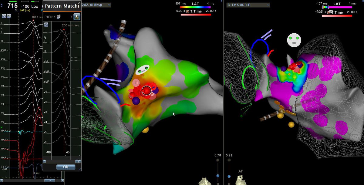 atrialappendage's tweet image. PVCs from many different area codes this week: 1. Aortomitral continuity, 2. Anterolateral RVOT, 3. Moderator band, 4. Right coronary cusp. Working on personal growth with low-no fluoro techniques #ICEisNice #EPeeps