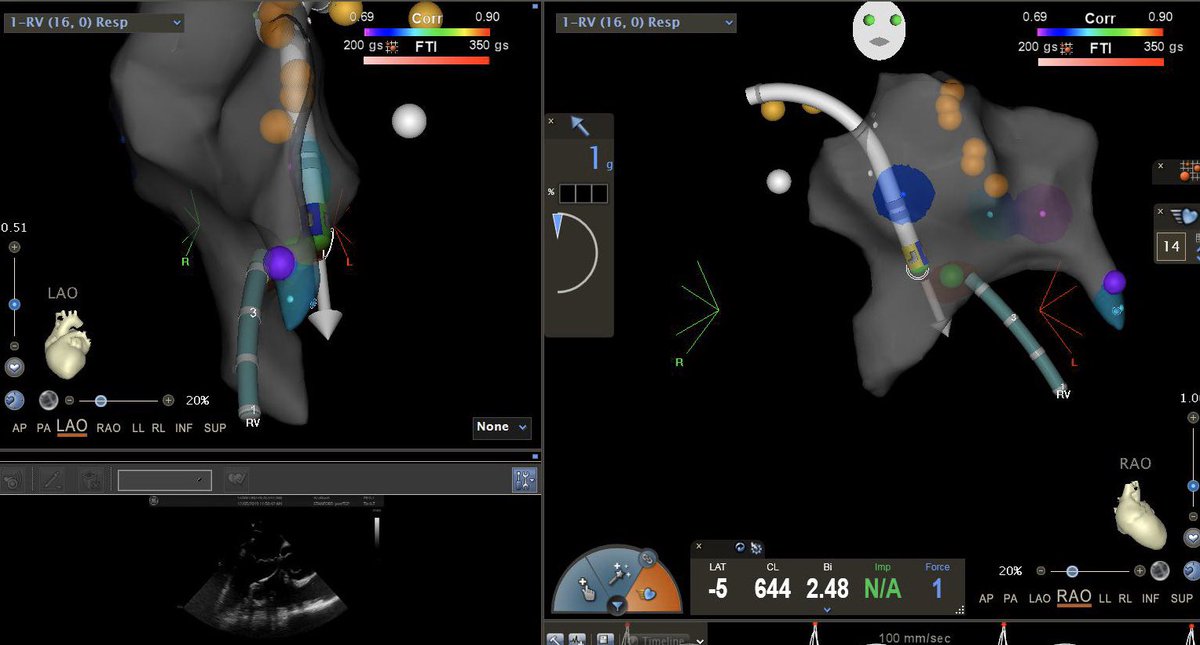 atrialappendage's tweet image. PVCs from many different area codes this week: 1. Aortomitral continuity, 2. Anterolateral RVOT, 3. Moderator band, 4. Right coronary cusp. Working on personal growth with low-no fluoro techniques #ICEisNice #EPeeps