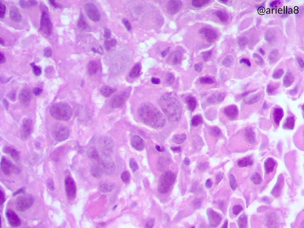 ariella8's tweet photo. #Thoraxicpath #CUP #IHCPath #Mytrucutbiopsies Male on 50s .11 cm posterior mediastinal mass .Your favored DX and IHC request 😊🙏 https://t.co/9USqh56qde