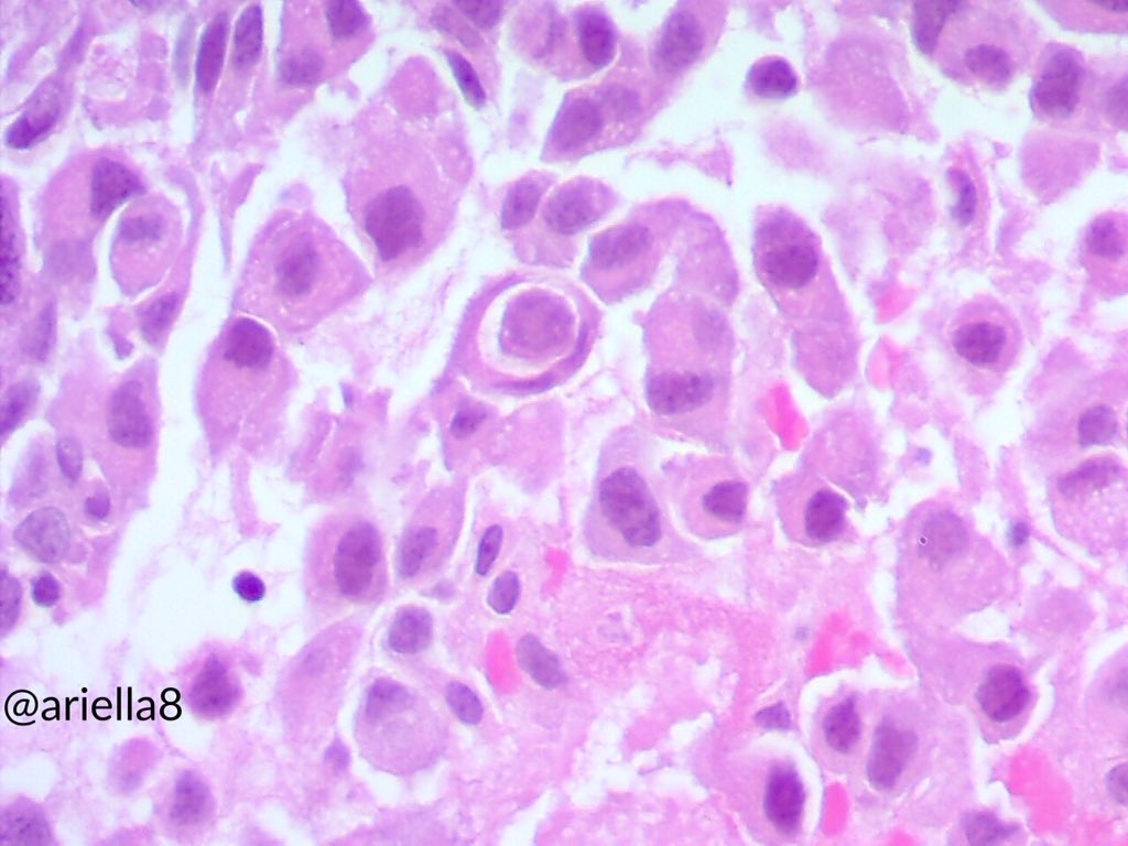 ariella8's tweet photo. #Thoraxicpath #CUP #IHCPath #Mytrucutbiopsies Male on 50s .11 cm posterior mediastinal mass .Your favored DX and IHC request 😊🙏 https://t.co/9USqh56qde