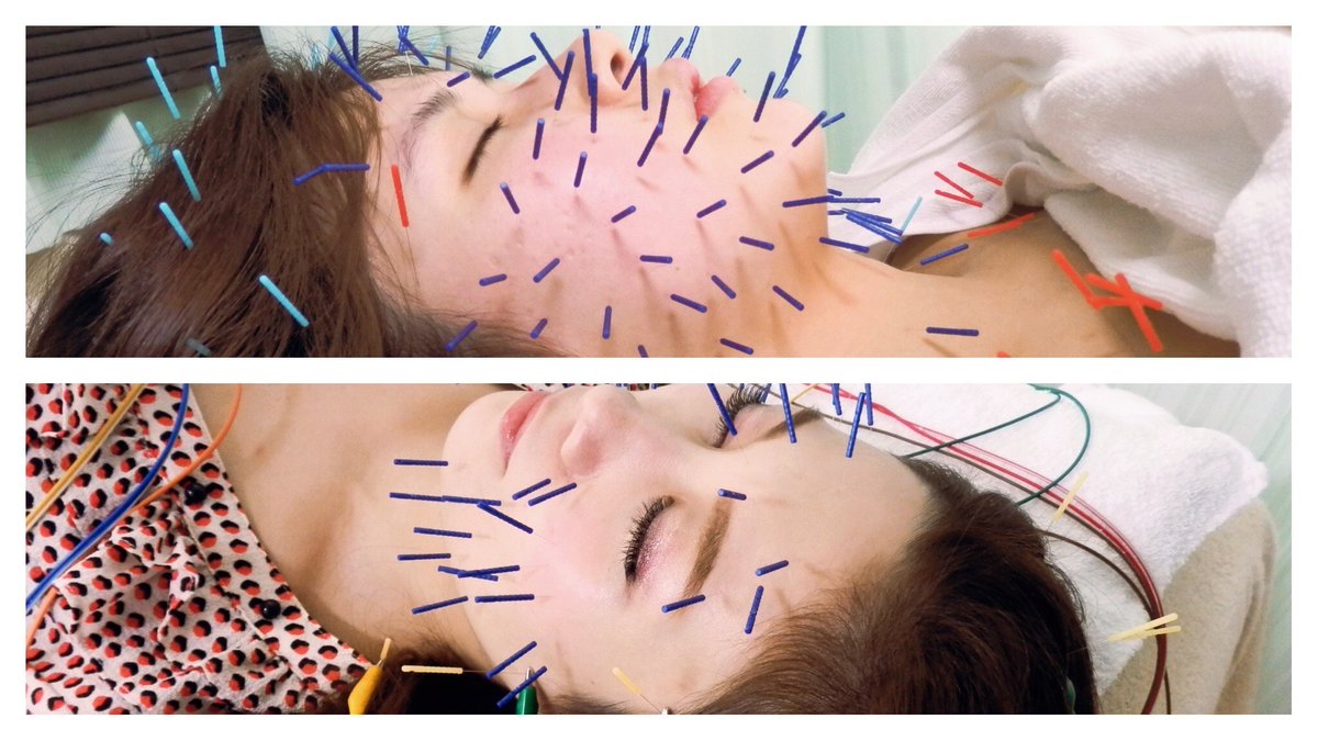 美容鍼とヒデ鍼灸院 東京都の渋谷 恵比寿 代官山 東京都の電気のヒデ鍼灸院 電流美容鍼と鍼灸ケア 冬のキャンペーン開催中 渋谷 恵比寿 代官山 T Co Zpzhjrfcto ご予約空き状況 更新致しました 美容鍼 美容鍼灸 ヒデ鍼灸院 鍼灸