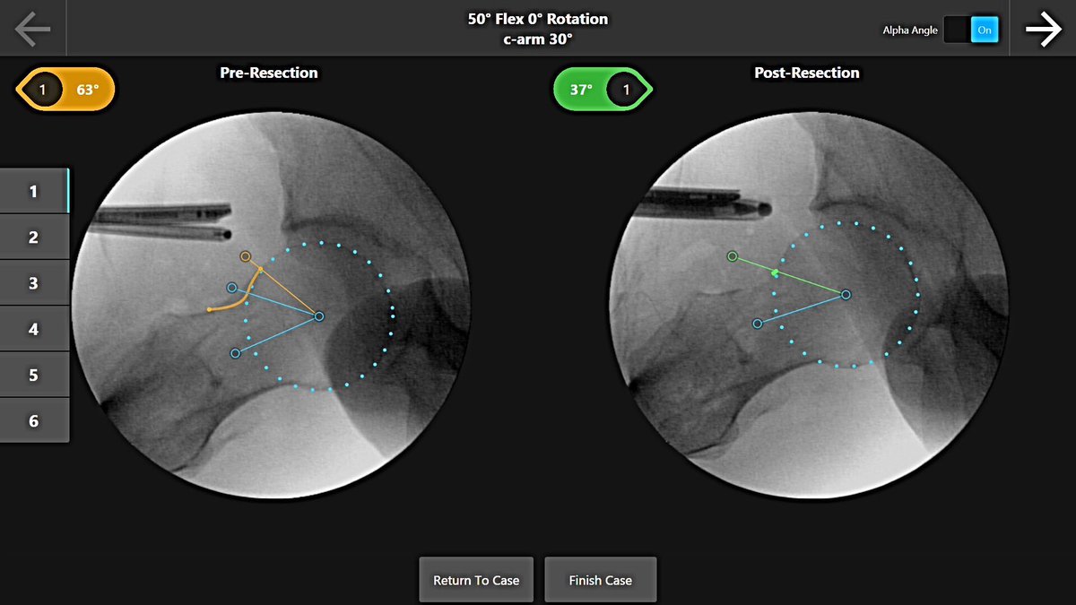 MaldonadoMD_'s tweet image. Intraoperative cam correction assessment  using #hipcheck in #hipFAI 
Useful tool, still same goals:
1. Impingement free movement (no under-resection)
2. Perfect sphere
3. Smooth head-neck junction transition
4. “Labral seal” preservation (no over-resection)
#hiparthroscopy