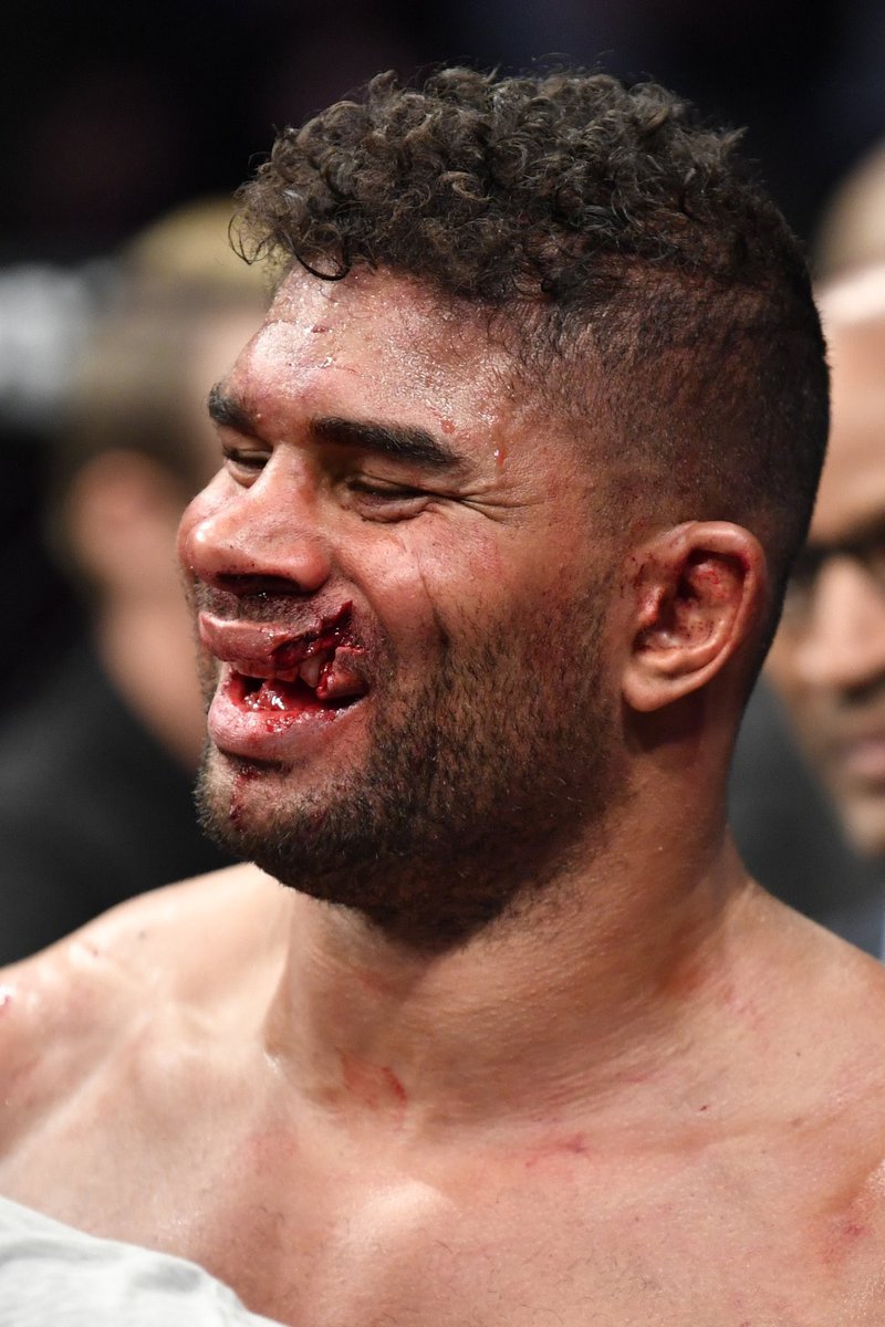 閲覧注意 K 1最強だったアリスター オーフレイム Ufcでホーゼンストライクのパンチを喰らい唇が裂ける 6ページ目 Togetter 閲覧注意 K 1最強だったアリスター オーフレイム Ufcでホーゼンストライクのパンチを喰らい唇が裂ける 6ページ目 Togetter