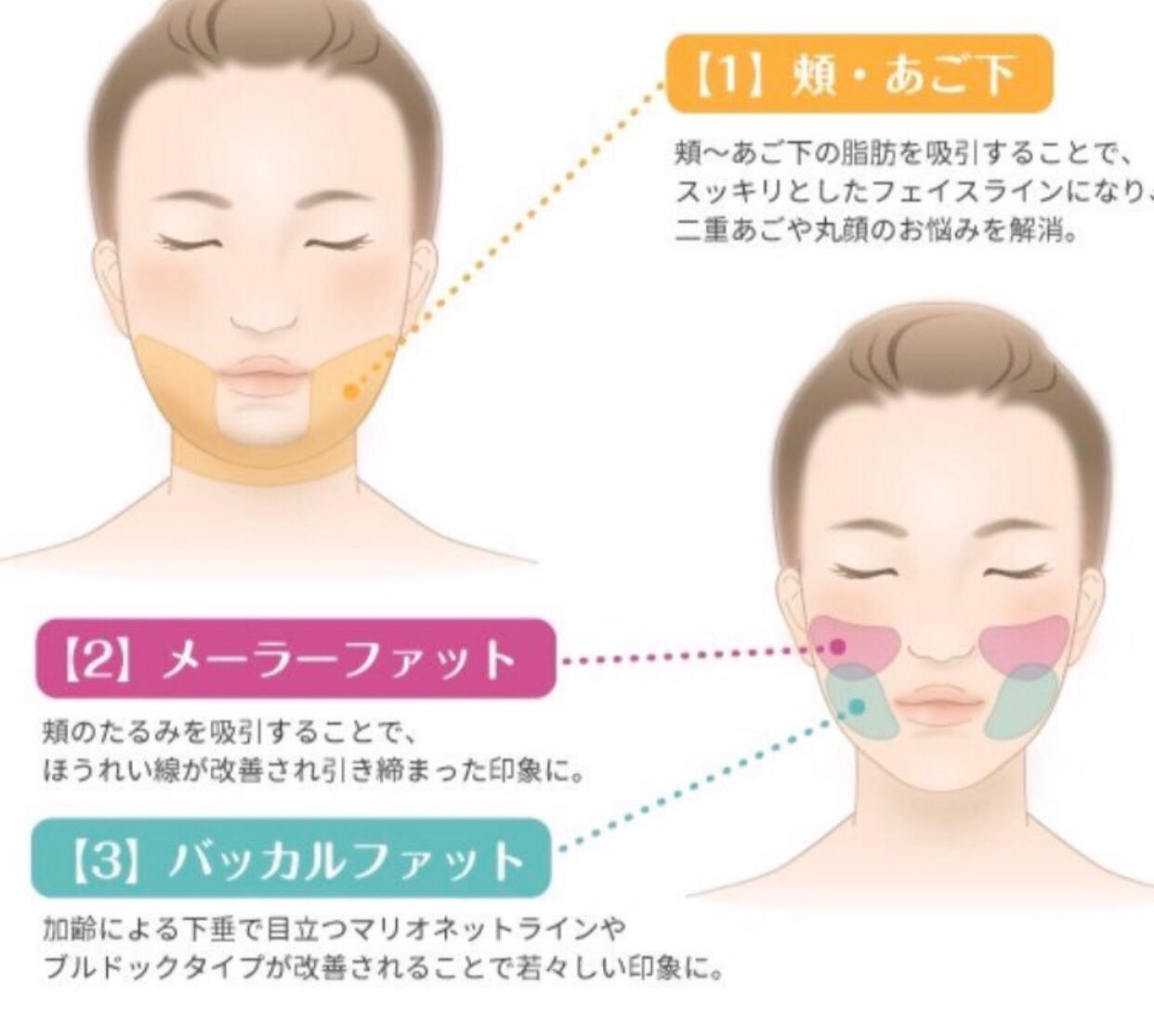 𓂃 室長さん 在 Twitter 上 顔の脂肪吸引まとめ 昔はバッカルファット取るのが流行ったけど今はメーラーファットが流行りつつあるね 適応の人がやると垢抜ける T Co Col3vijskf Twitter