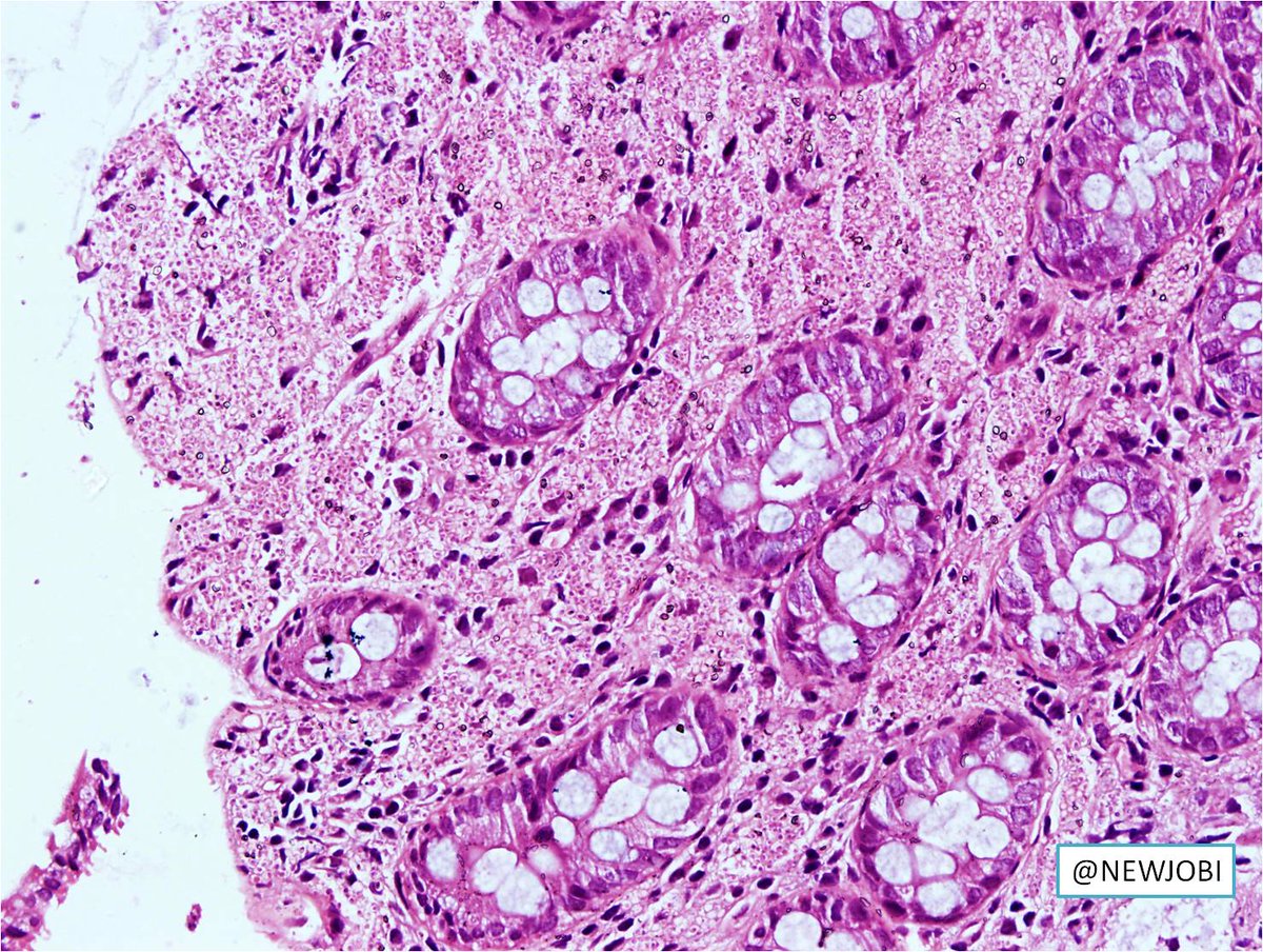 NewjobiRakesh's tweet image. Young female with multiple colonic ulcers, lymphadenopathy #pathology #GIpath