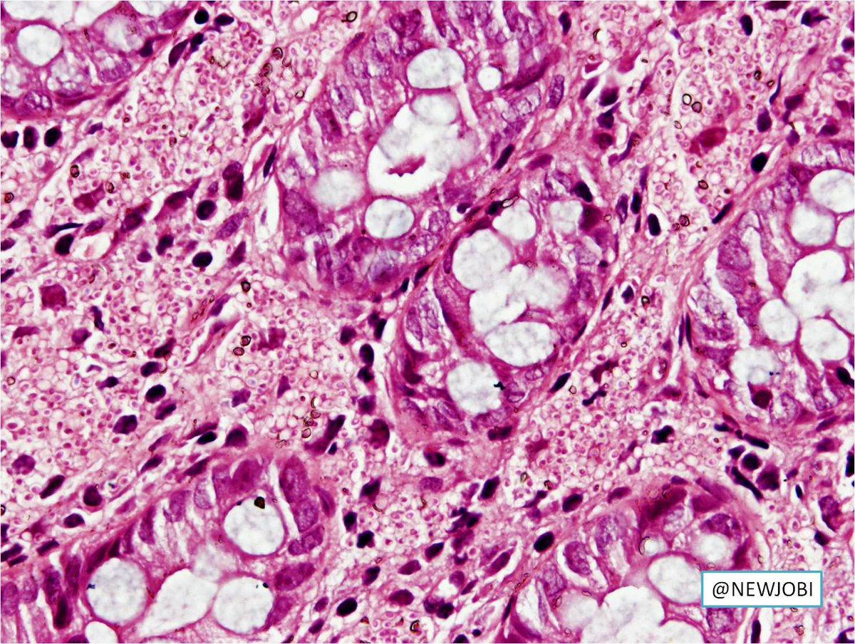 NewjobiRakesh's tweet image. Young female with multiple colonic ulcers, lymphadenopathy #pathology #GIpath