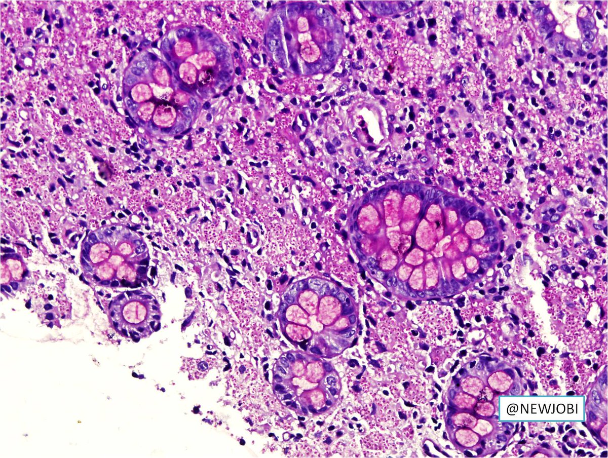 NewjobiRakesh's tweet image. Young female with multiple colonic ulcers, lymphadenopathy #pathology #GIpath