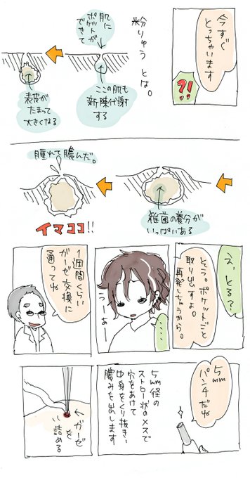 粉瘤のtwitterイラスト検索結果 古い順 粉瘤のtwitterイラスト検索結果 古い順