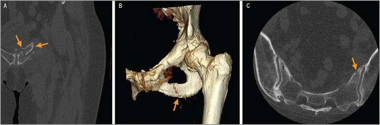 JOSPT's tweet photo. This #MSKMonday we have a curious case of the 'not to be missed' 😬

To see the full case head over to the @JOSPT website - https://t.co/q3HJu3KwjN

#PelvicRing #Fracture #Imaging #Physio #Radiography #yourJOSPT https://t.co/QFa9WsIXWf