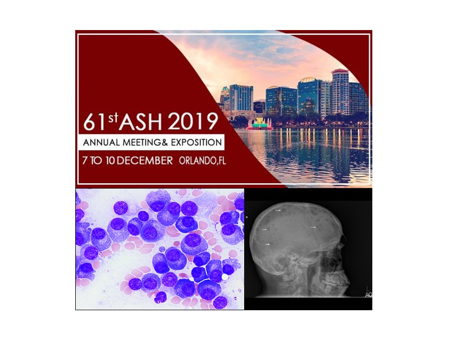 MULTİPLE MİYELOM: AŞİKAR HALE GELMEDEN YOK EDİLEBİLİR Mİ? 
#daratumumab #hematolojiistanbul #memorialataşehirhematoloji #MGUS #miyelomtedavisi #multiplmiyelom #multiplemyeloma #profdrhisari #Smolderingmyeloma profdrhisari.com/multiple-miyel…