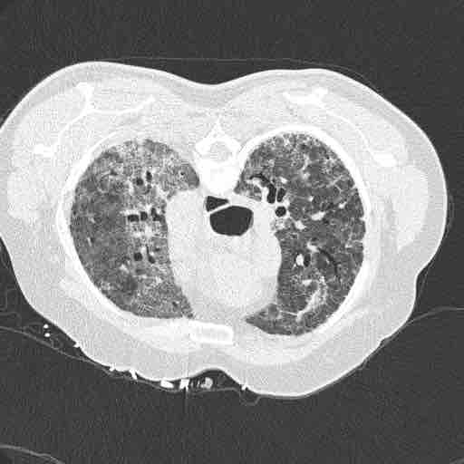 Monday Morning ConsultA pulmonologist colleague shows you this CT chest (photo).Who is the host?What is the syndrome?What is the risk factor?What is the pathogen?Details and MCQ later.....