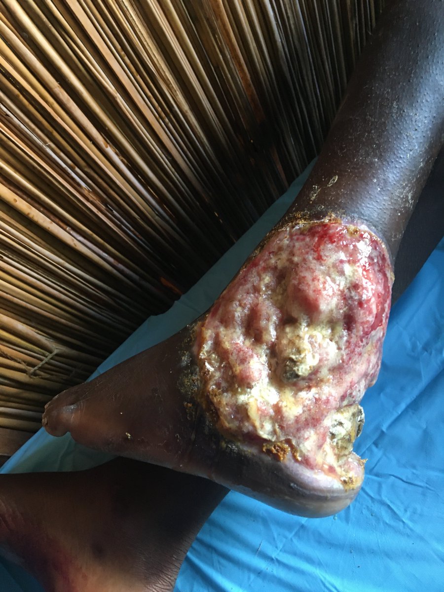 IMOutreach's tweet photo. 🚨GRAPHIC IMAGE🚨

Very aggressive wound with exposed necrotic bone on a 12-year-old boy. https://t.co/kwt4dk8XSO
