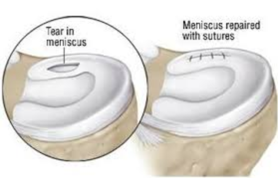 DrNikhilVerma's tweet photo. How is a #meniscus root repair performed?
A #MeniscusRootRepair is done by taking the torn meniscal root and tacking it down to the bone, using strong sutures.
Click here to learn about the recovery: https://t.co/WZHREcTeb4 https://t.co/jAHnWEjFSi
