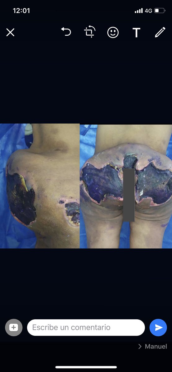 DrHugoRicardo's tweet photo. A propósito de #POSE muestran una problemática de salud muy seria aunque no dan el panorama completo: aquí un poco del tema de la utilización de biopolimeros o modelantes utilizados ilegalmente con fines estéticos #modelantes #contornocorporal #plasticsurgerymexico https://t.co/Z0bptuah1D