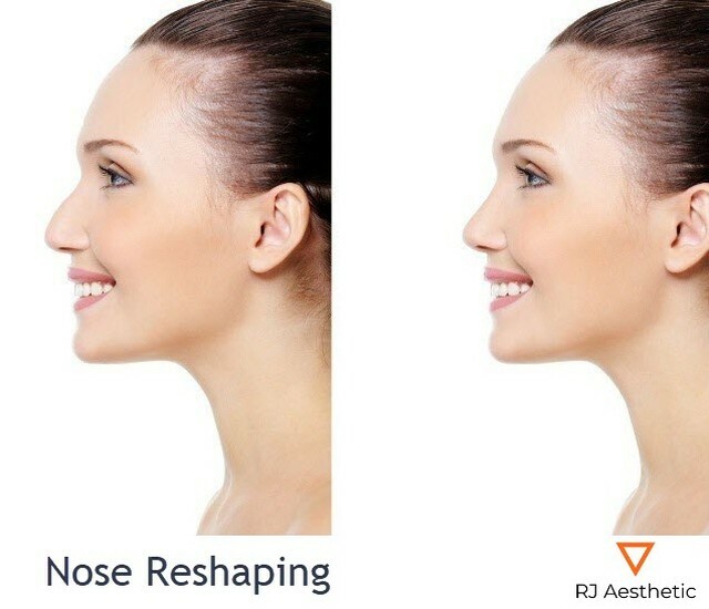 rjaesthetic's tweet photo. 🧡 You can use dermal fillers for correcting imperfections of the nose. They can help shape, contour and straighten a nose to give you the look you always wanted. 😘

https://t.co/rmX4Zz4fZX

Visit us now in one of our clinics:
🔸 Ilford
🔸 Seven Kings
… https://t.co/0MvvmyK7Vt https://t.co/zcTRacTM9N