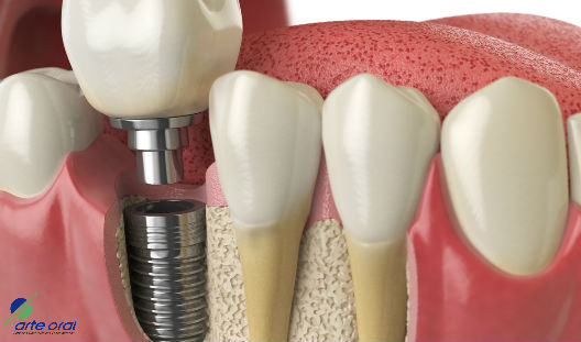 Arte_Oral's tweet photo. Estas son las razones para realizarte una rehabilitación oral junto a los beneficios que traerá para tu salud y estética dental. Haz clic aquí: https://t.co/yB5Z7FYvlQ
#EstéticaDental #SaludOral
.
.
Puede interesarte: Tipos de retenedores: https://t.co/gxMrsdd0h7 https://t.co/HJNUJhKjHN
